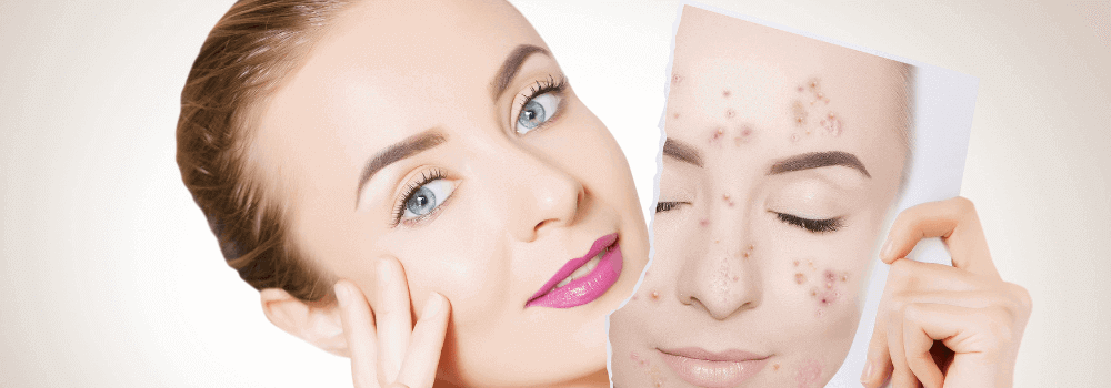 Woman showcasing transformation using Natural Skincare Products for acne treatment.